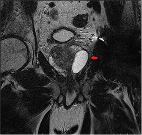 A Large Benign Prostatic Cyst Presented With An Extremely High Serum Prostate Specific Antigen