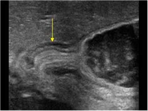 Antral Contractions That Could Be Mistaken For A Pyloric Hypertrophy
