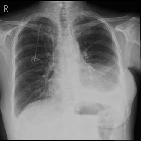 Pleural effusion is the term for fluid accumulation in the pleural space around the lungs. Malignant pleural effusion - Radiology at St. Vincent's ...