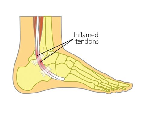 What Is Peroneal Tendonitis And How To Manage Foot Pain Upswing Health