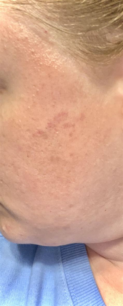 Guidance Needed Yall Whats Wrong With My Skin What Are These