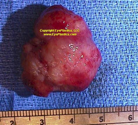 Hemangiopericytoma Boise Orbital Tumor Idaho