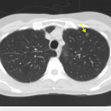 CT Scan Of The Chest Demonstrating A Mm Left Upper Lobe Pulmonary