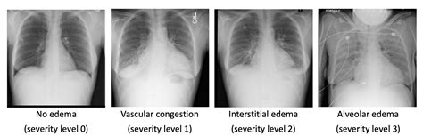 Clinical presentation the clinical one method of classifying pulmonary edema is as four main categories on the basis of pathophysiology which include Quantification of Pulmonary Edema in Chest Radiographs ...