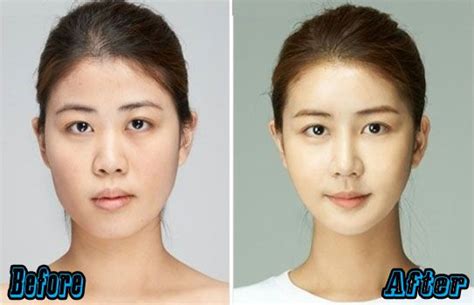 South Korean Plastic Surgery Cost And Procedures Korean Plastic Surgery Cost South Korean