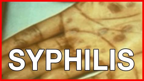 What Is Syphilis Stages Of Syphilis And Symptoms Youtube