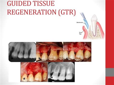 Furcation Involvement Ppt