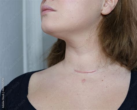 Scar On The Neck Surgical Wounds Removal Of Tumor And Thyroid Cancer