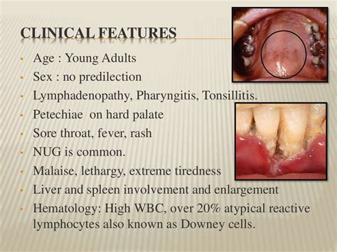 Viral Infections Oral Cavity