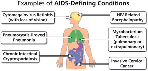 Aids Defining Condition Nih