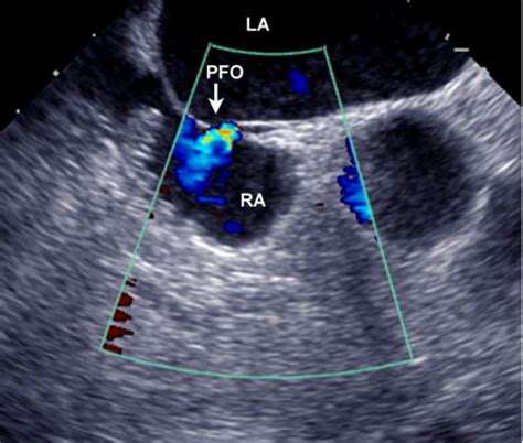 Transesophageal Echocardiography A Patent Foramen Oval Open I