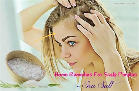 17 Home Remedies For Scalp Pimples And Acne Treatment