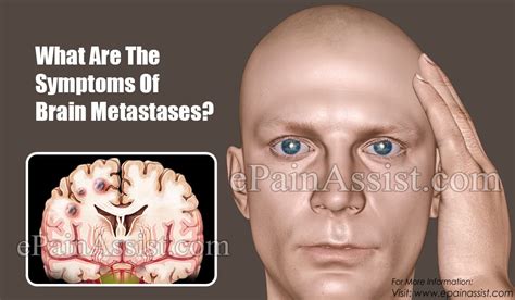 What Are The Symptoms Of Brain Metastases