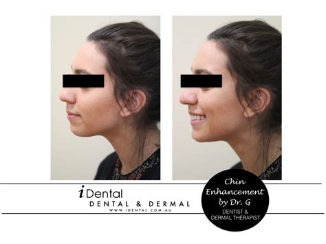 5 At Home Treatments To Improve The Appearance Of A Sagging Jawline
