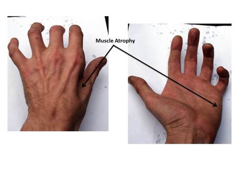Ulnar Neuropathy At The Elbow Cubital Tunnel Syndrome Neuromuscular