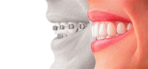 Invisalign Vs Traditional Braces The Pros And Cons Of Two Orthodontic Treatments