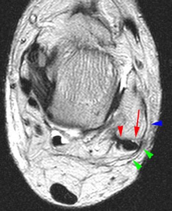 If the lateral retinaculum is too tight, it can pull the patella laterally and cause pain. MRI Musculo-Skeletal Section: Normal anatomy of peroneus ...