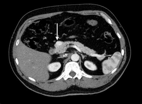 Cureus Pancreatic Insulinoma Case Report Of Rare Tumor