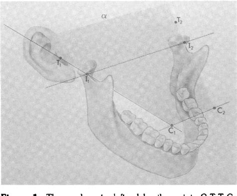 Figure 1 From The Gow Gates Technique For Mandibular Block Anesthesia