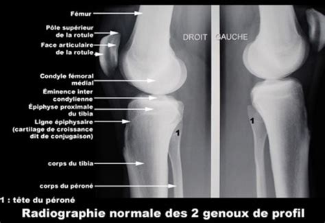 Image Photo Genou De Profil Radiographie Normale Imagerie Médicale
