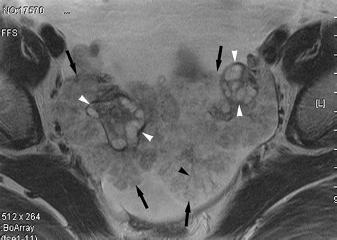 Borderline Serous Surface Papillary Tumor Of The Ovary Mri