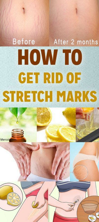 How To Get Rid Of Stretch Marks Naturally