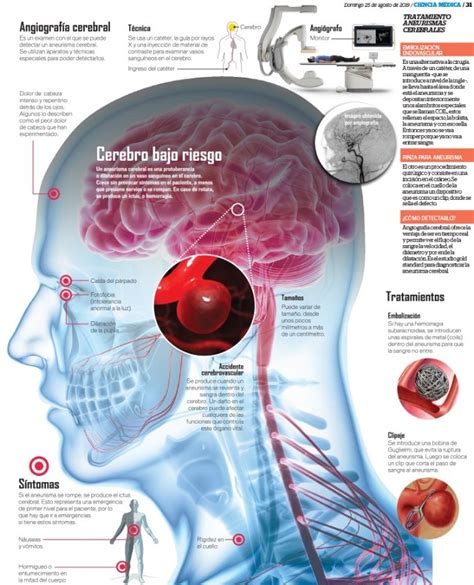 Learn the risks, signs, symptoms, and treatments for aortic aneurysms. Aneurisma cerebral: No esperes a que se rompa | Prensa Gráfica