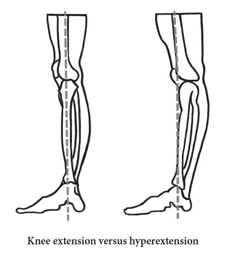 What Is Knee Hyperextension — Doctor Yogi