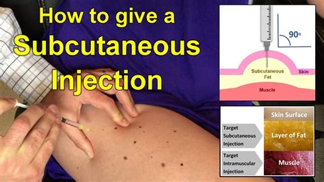 Subcutaneous Injection Technique For Nurses