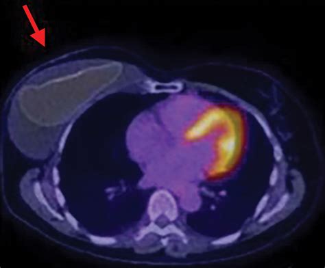 Breast Implantassociated Anaplastic Large Cell Lymphoma Review And