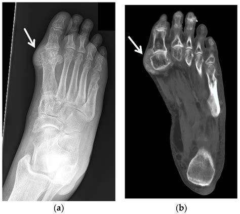 JCM Free Full Text Gouty Arthropathy Review Of Clinical