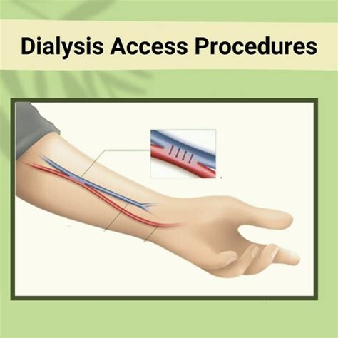 Dialysis Access Procedures Arteriovenous Fistula Dialysis Access