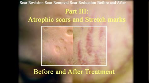 Part Iii Atrophic And Acne Scars And Stretch Marks Before After