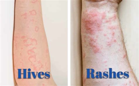 Rash Vs Hives How To Identify And Treat Them Naturally