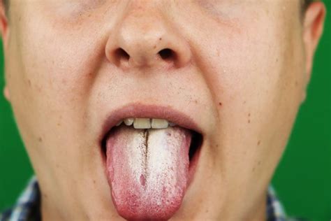 Oral Thrush Home Remedies Causes Symptoms And More Ask The Dentist