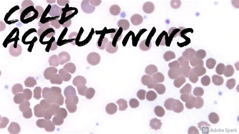 Cold Agglutinins On Peripheral Blood Smear Youtube