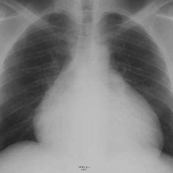 Usp standards for drug reference standards are used to demonstrate identity, strength, purity and quality for medicines, dietary supplements and food ingredients. Pericarditis - Trastornos cardiovasculares - Manual MSD ...