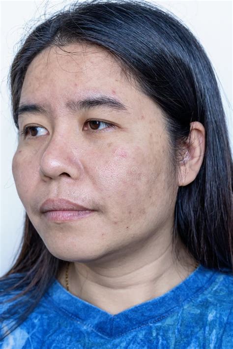 Close Up Of Asian Adult Woman Face Has Freckles Large Pores Blackhead