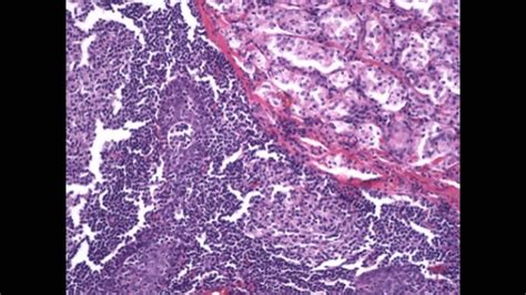 Histopathology Thyroid Diffuse Hyperplasia Graves Disease Youtube