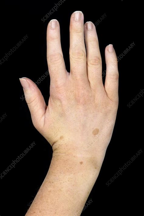 Congenital Moles On The Hand Stock Image C0461010 Science Photo
