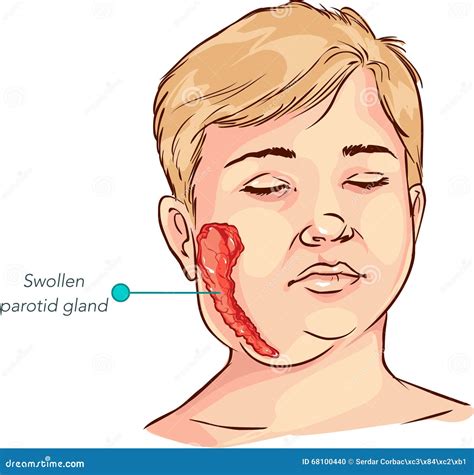 Children Salivary Gland Swelling Vector Illustration Stock Vector