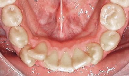 Unter diskrepanz (von lateinisch discrepantia ‚nichtübereinstimmung', ‚uneinigkeit') versteht man allgemein ein missverhältnis zwischen zwei sachen und deren nichtübereinstimmung oder widersprüchlichkeit. Parodontitis (Gingivitis - Parodontose) - Prof. Dr. med ...