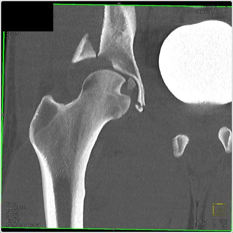 Fracture Acetabulum With Hematoma And Dislocation With Bone Fragment In