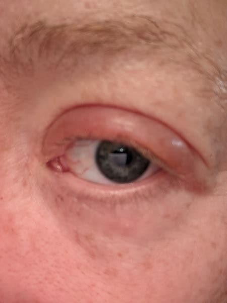 Swollen Eyelid What Is It And How To Treat Mumsnet