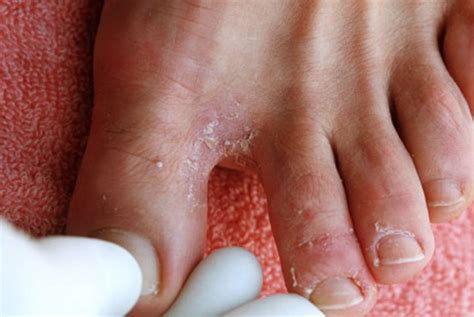 Foot Fungus Pictures Types Causes Symptoms Treatment 2018