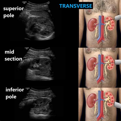 Renal Ultrasound Complete Protocol Sonographic Tendencies