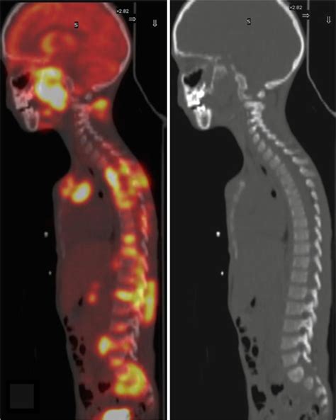 Lymphoma Radiology Key