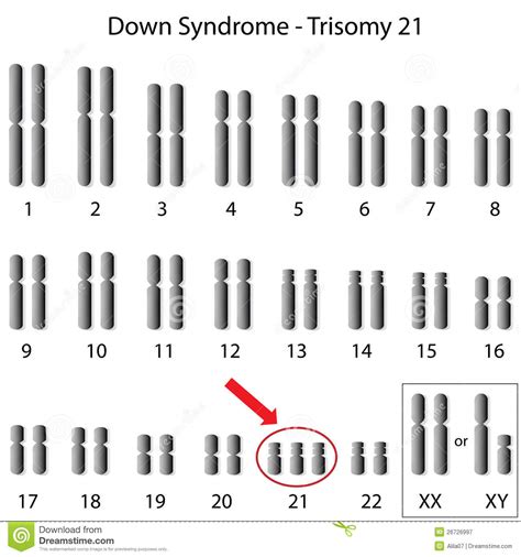 In canada, approximately 1 in. Down syndrome stock vector. Illustration of biological ...