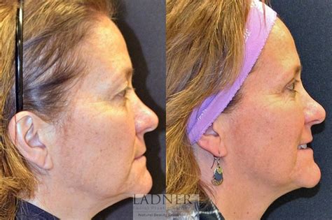 Eyelid Surgery Blepharoplasty Before And After Photo Gallery Denver CO Ladner Facial