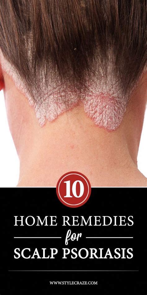 12 Best Home Remedies To Improve Scalp Psoriasis Effectively